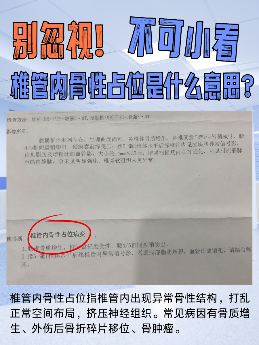 别忽视！椎管内骨性占位是什么意思？不可小看