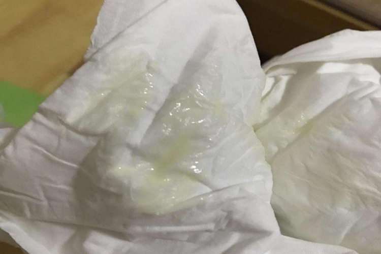 黄水样白带图 黄水样白带图