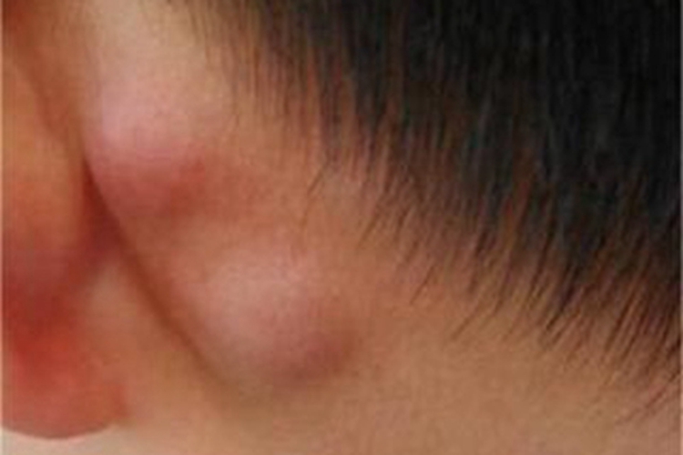 婴幼儿化脓性淋巴结炎耳后症状图