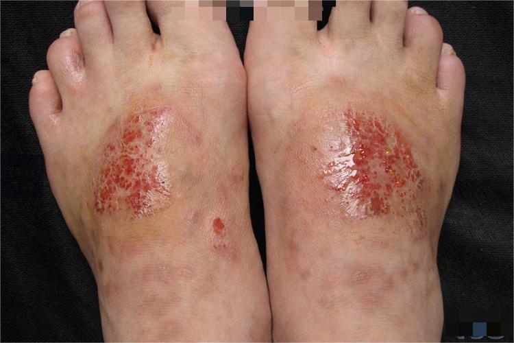 湿疹脚背糜烂图
