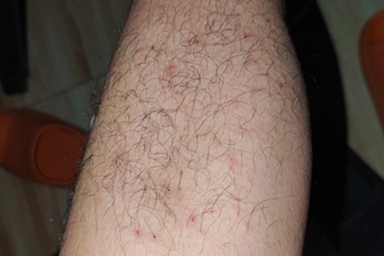 跳蚤叮咬小腿红点图