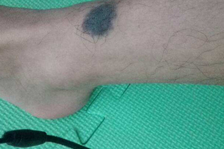 复合痣小腿症状图 复合痣小腿症状图