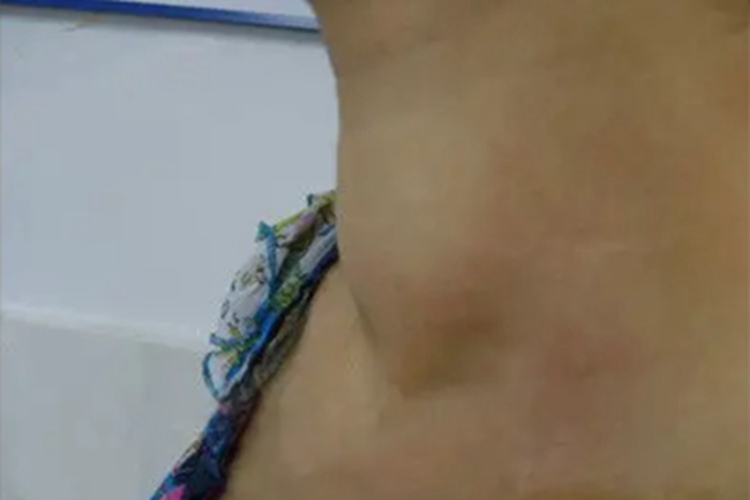 甲状腺囊肿症状图