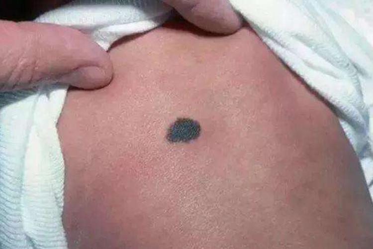 新生儿色素痣图