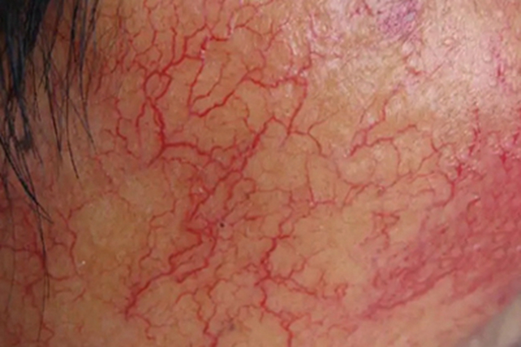糖皮质激素依赖性皮炎面部血丝图