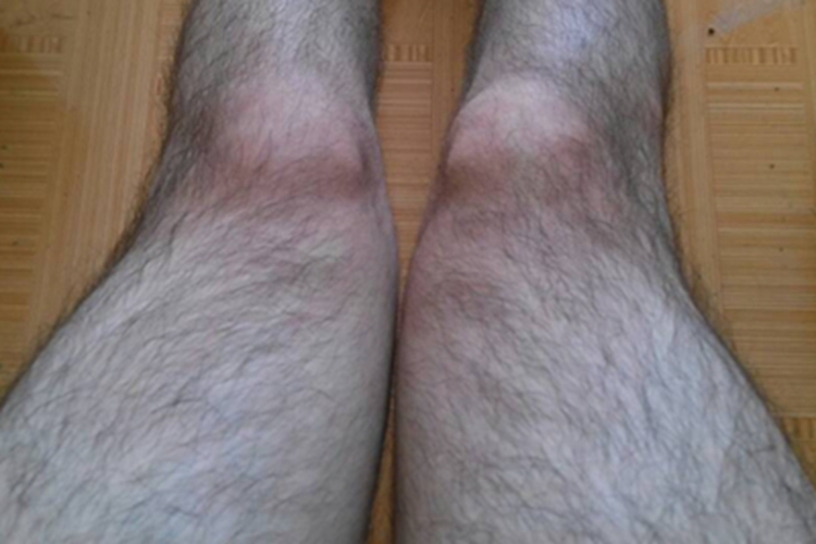 女性多毛症双腿上长密集毛发图 女性多毛症双腿上长密集毛发图