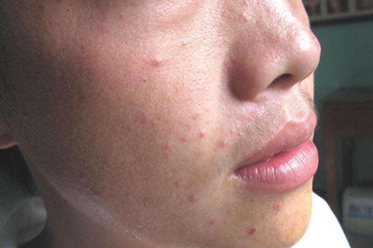 马拉色菌毛囊炎面部疙瘩图