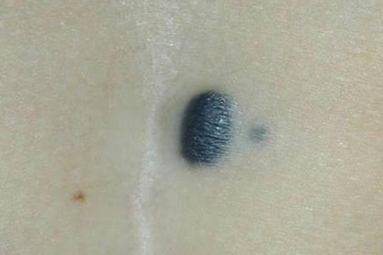 细胞性蓝痣图 细胞性蓝痣图