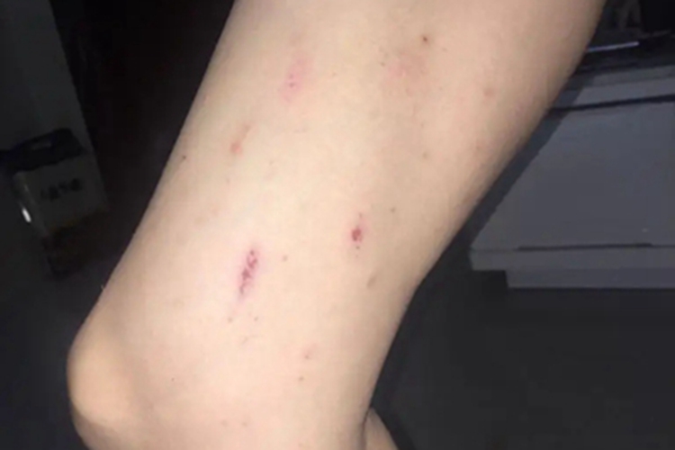 神经官能症性表皮剥脱大腿结痂图