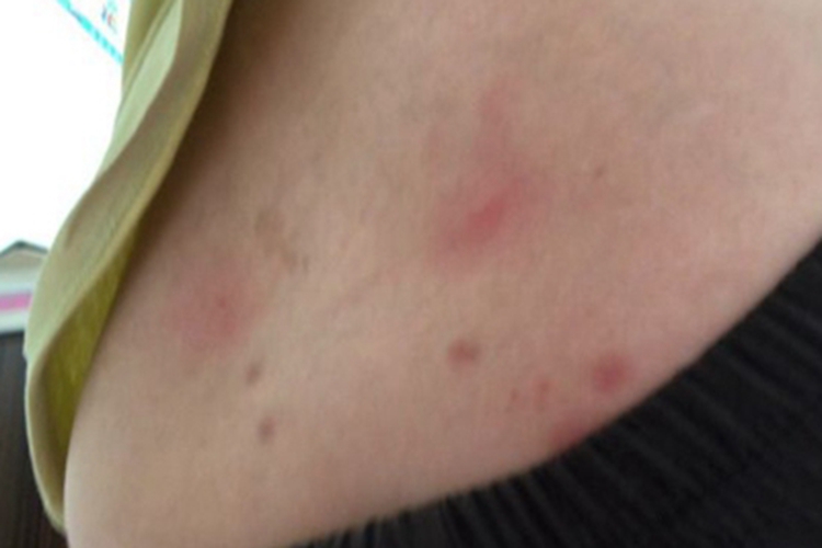 跳蚤叮咬背部小红疙瘩图