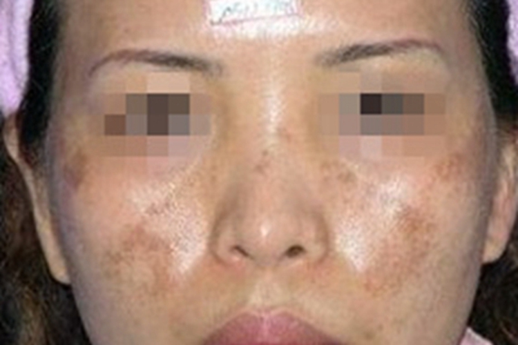 黄褐斑脸颊有黄褐色斑点图 黄褐斑脸颊有黄褐色斑点图