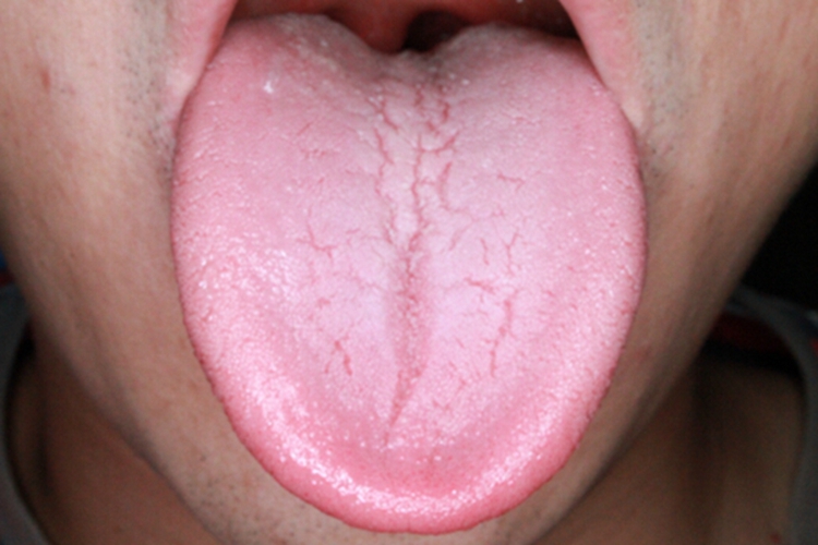 沟纹舌舌头裂纹图