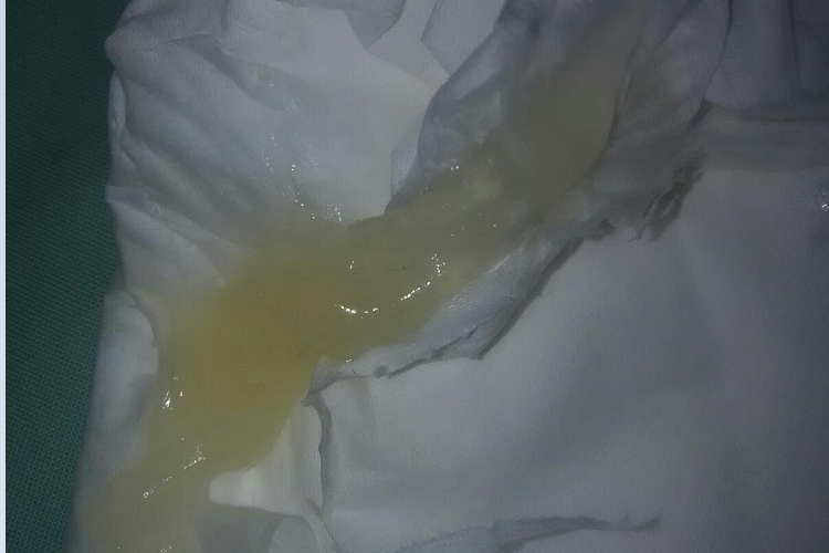 滴虫性阴道炎分泌物图