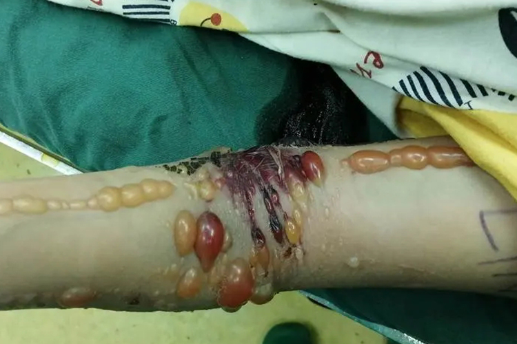 上肢骨折张力性水疱图 上肢骨折张力性水疱图