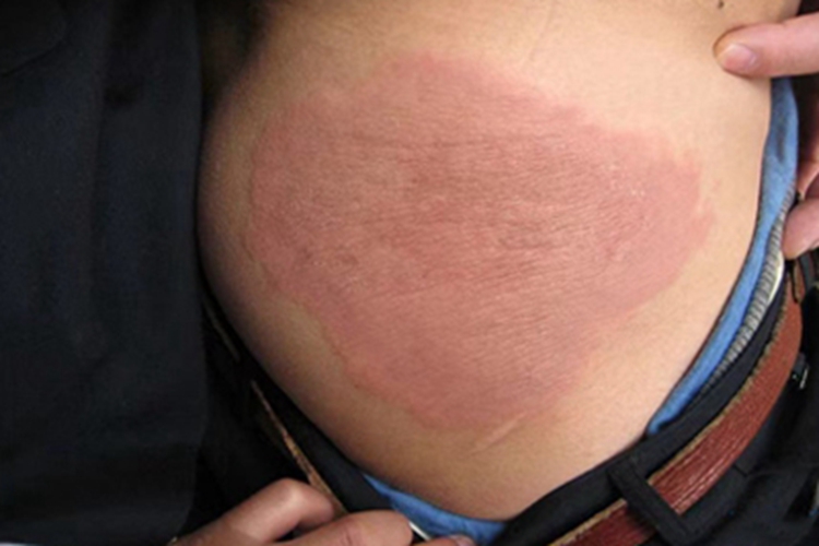 海水浴者皮疹臀部症状图 海水浴者皮疹臀部症状图