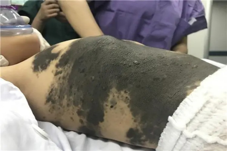 兽皮痣腹部症状图