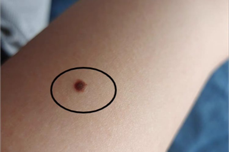 皮内痣胳膊疙瘩图