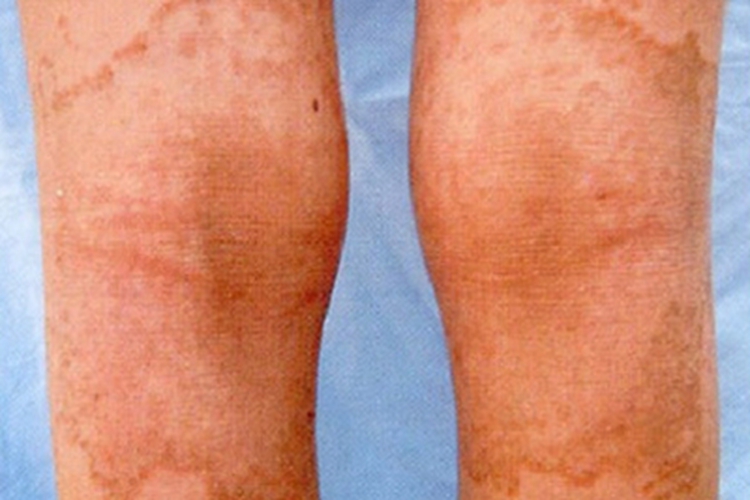 变异性红斑角化病腘窝症状图