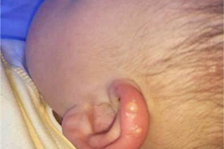 虫咬皮炎耳廓小水疱图