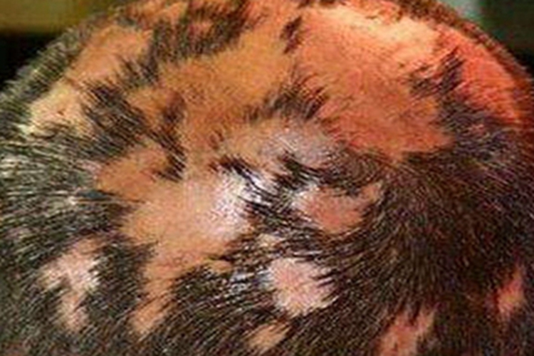 假性斑秃头发快掉没了图