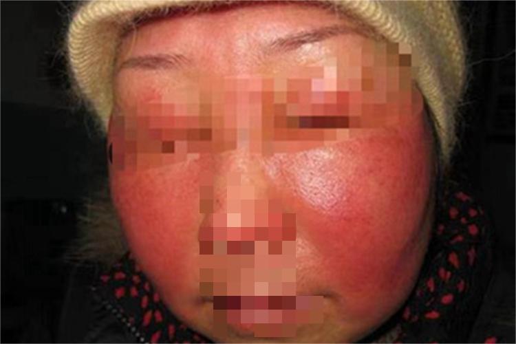 光接触性皮炎面部红肿图