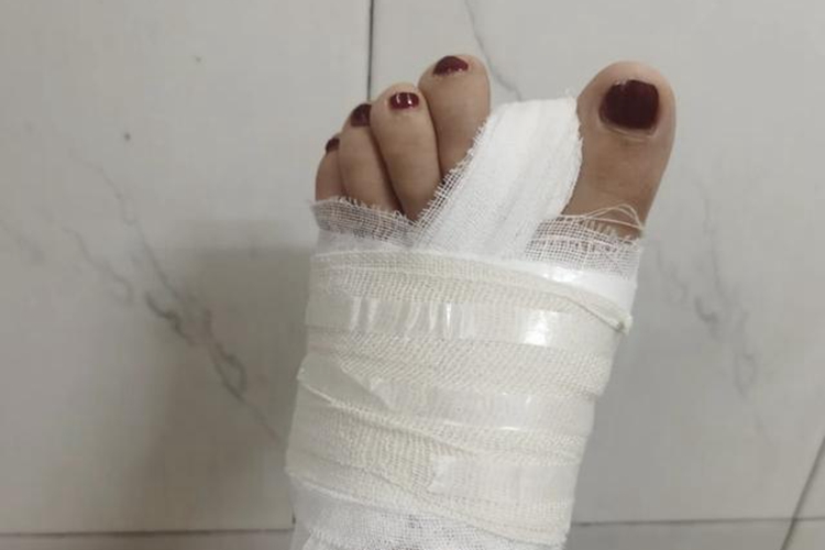 拇外翻微创手术后图