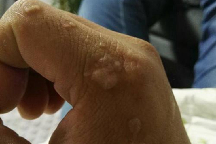 扁平疣样职业性疣赘手部症状图 扁平疣样职业性疣赘手部症状图