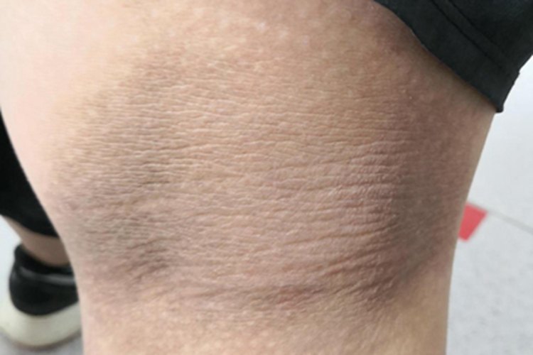 黑棘皮病皮肤增厚图