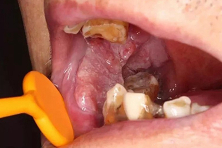 颊癌口腔白斑图