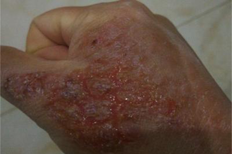 急性湿疹裂口图 急性湿疹裂口图