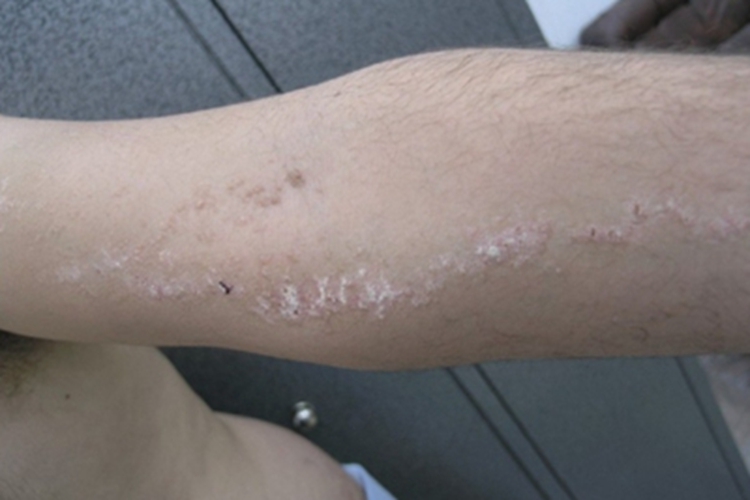 线状疣状表皮痣脱屑图