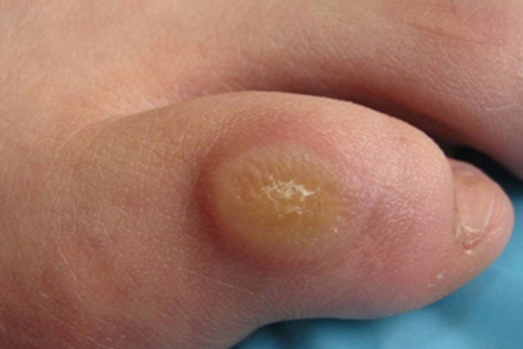 硬鸡眼脚部大疙瘩图 硬鸡眼脚部大疙瘩图