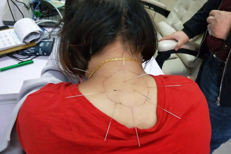 颈椎针灸图 颈椎针灸图