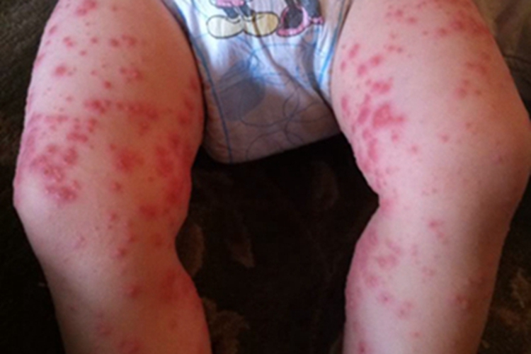 手足口病腿上长大片红疙瘩图