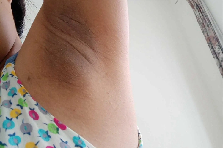 炎症后色素沉着图