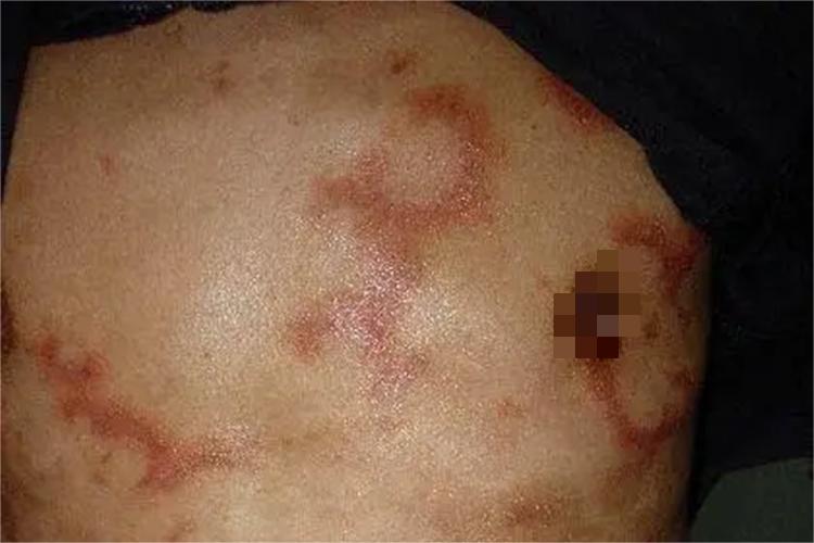风湿性环状红斑胸部症状图