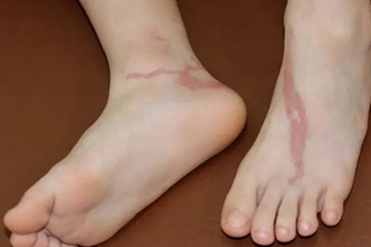 丝虫病急性期脚部症状图