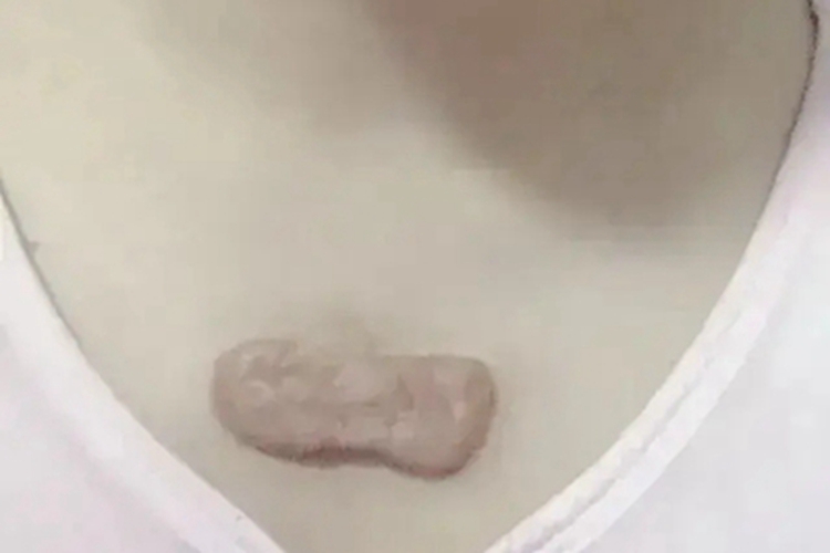 瘢痕疙瘩胸前长淡红斑图