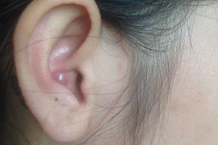 毛发囊肿小疙瘩图