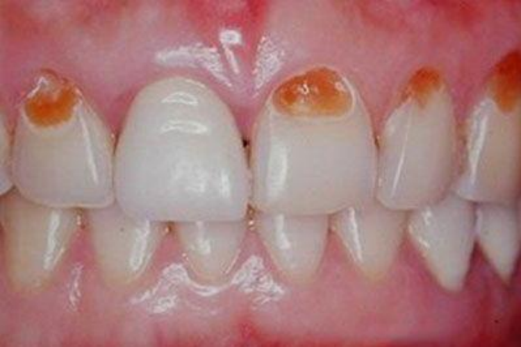 逆行性牙髓炎图