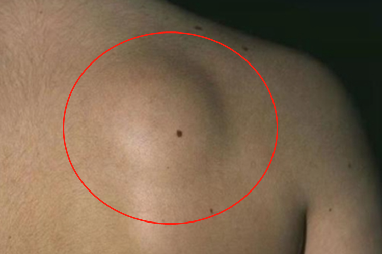 脂肪瘤肩部肿块图