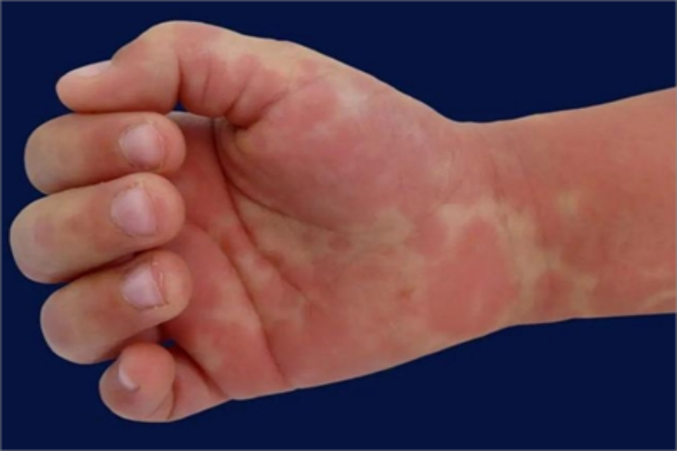 川崎病手掌红斑图