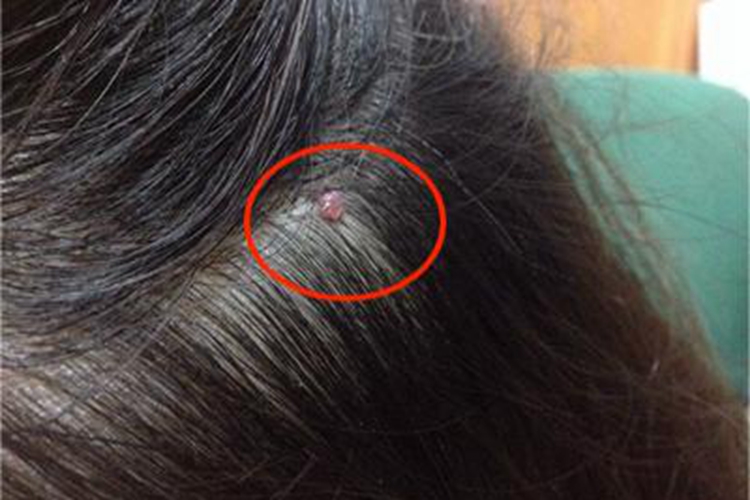 单发性有蒂软纤维瘤头皮小疙瘩图 单发性有蒂软纤维瘤头皮小疙瘩图