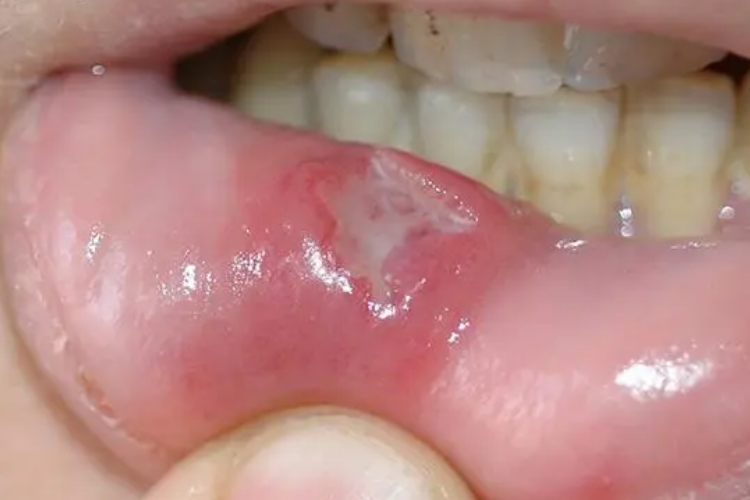 重型阿弗他溃疡图 重型阿弗他溃疡图