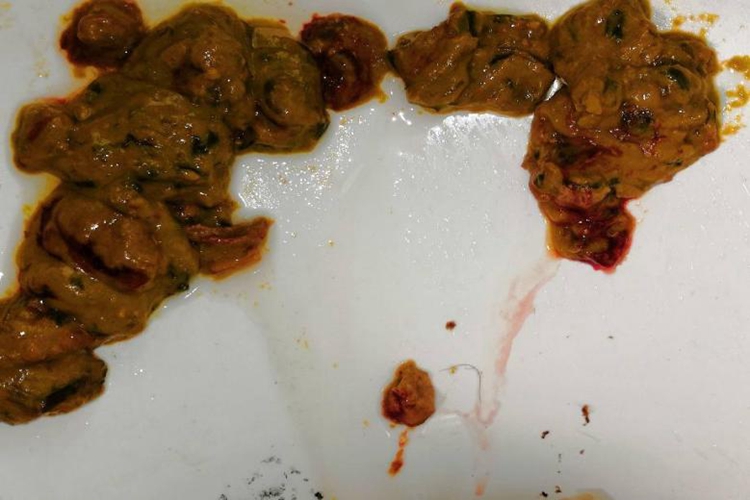 细菌性痢疾大便带血图