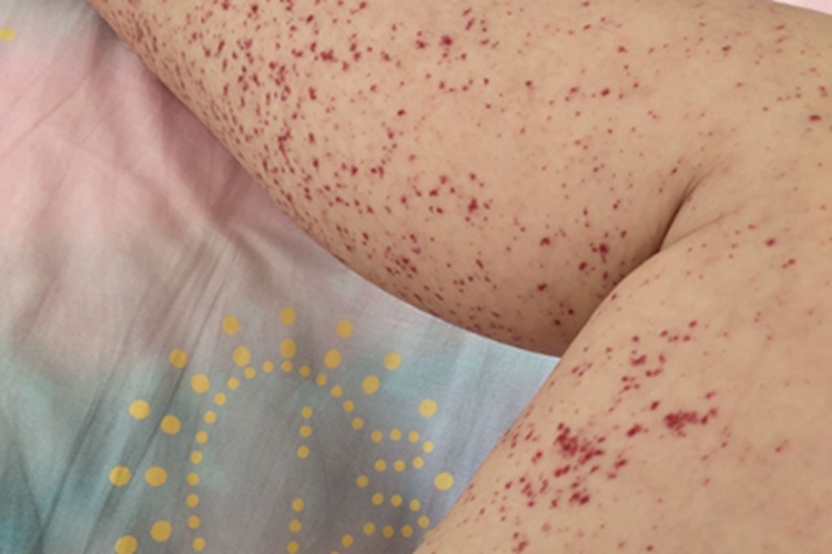 过敏性紫癜小腿出现紫斑图