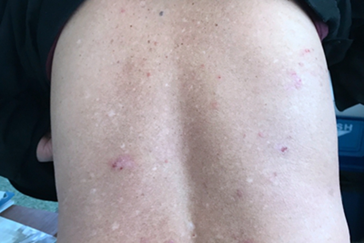 慢性湿疹红点图