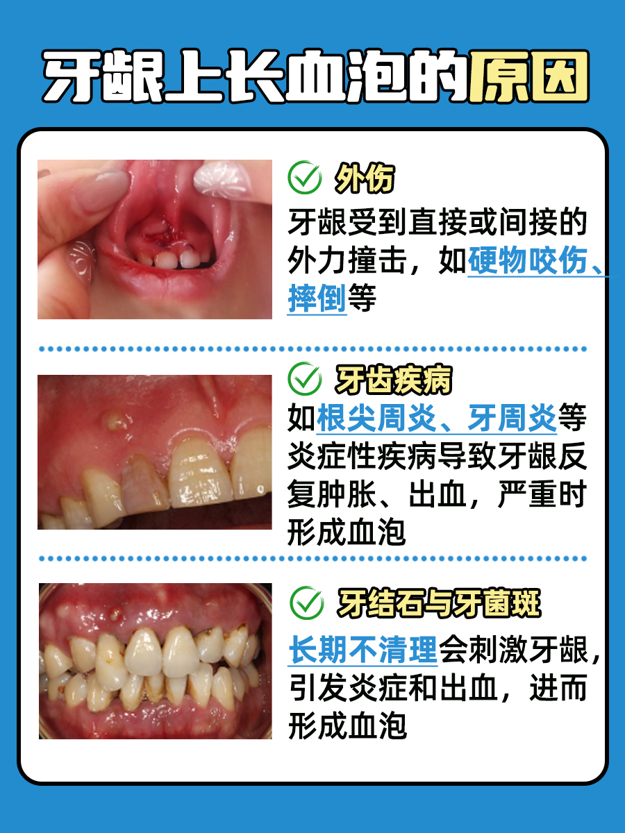 牙龈上长了个血泡图片