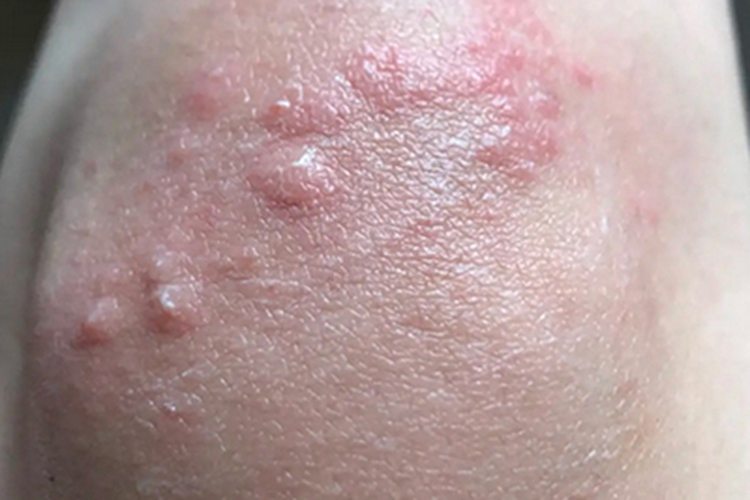 麻疹膝盖红色斑疹图