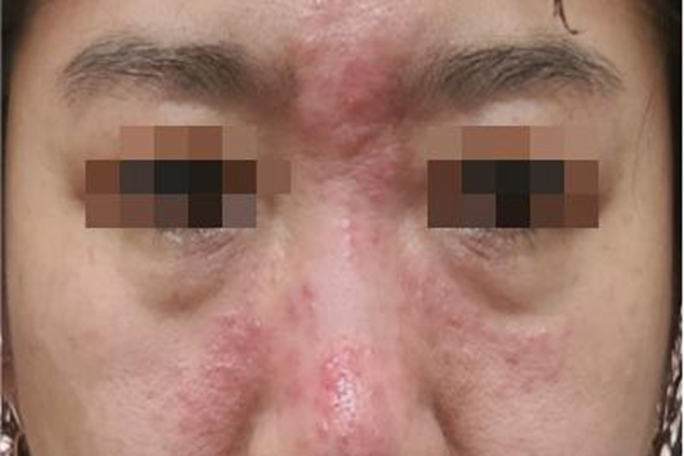 昆虫性皮炎面部丘疹图 昆虫性皮炎面部丘疹图